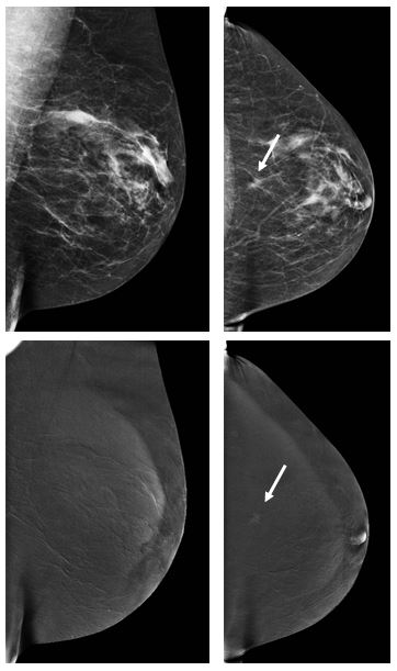 Contrast–enhanced mammography: Is a single view enough?