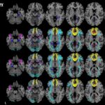 Early diagnosis of dementia with MRI