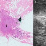 A new method for breast imaging?