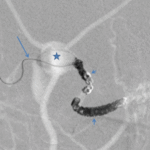 Transjugular coiling of a Cognard IV dural arteriovenous fistula using a new monopolar detachable coil system through a flow-directed microcatheter