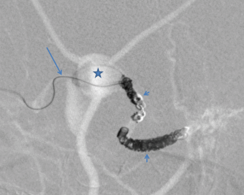 Transjugular coiling of a Cognard IV dural arteriovenous fistula using a new monopolar detachable coil system through a flow-directed microcatheter