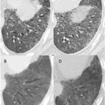 Letter to the Editor: “Could bronchiectasis in post-acute sequelae of COVID-19 be reversible?”