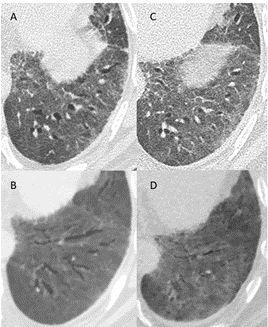 Letter to the Editor: “Could bronchiectasis in post-acute sequelae of COVID-19 be reversible?”