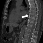 Whole body CT with only 1.5 mSv detects osteolytic lesions