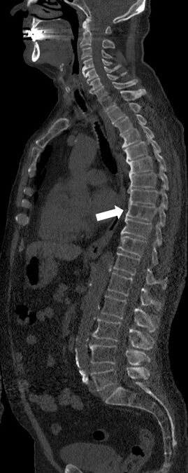 Whole body CT with only 1.5 mSv detects osteolytic lesions
