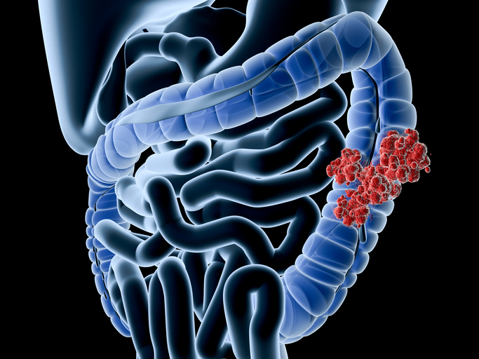 The impact of CT colonography